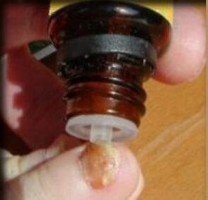 Aplikácia kvapiek na necht na nohe postihnutý plesňou