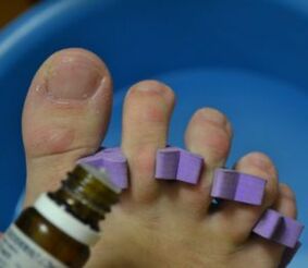 Príprava na ošetrenie nechtov kvapkami proti plesniam